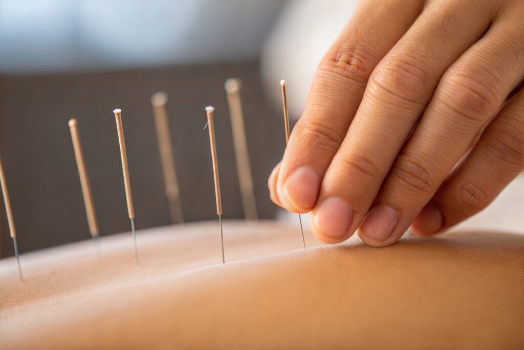 asian hand inserts acupuncture needles into soft skin to promote healing and wellness